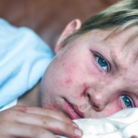 child_measles-1296x728-header.jpg