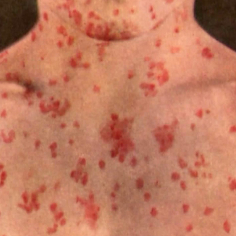 measles_1.jpg