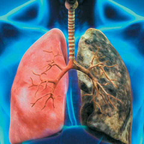 Καρκίνος του πνεύμονα