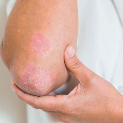 psoriasis-530693162-57810efc3df78c1e1ff59599.jpg