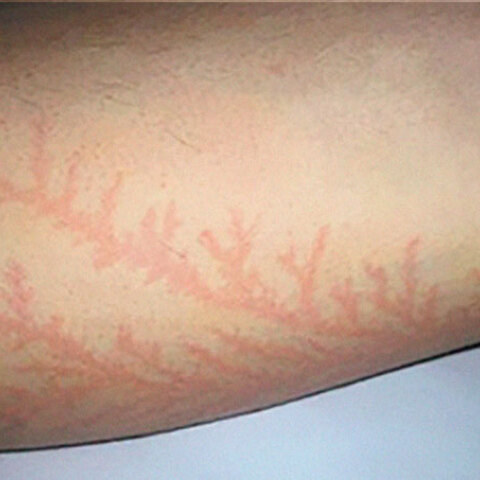 scars-after-surviving-lightning-strike-lichtenberg-figures-photos-3-5b6d321fb308f_700.jpg