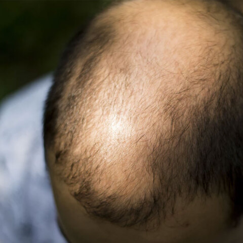 baldness.jpg