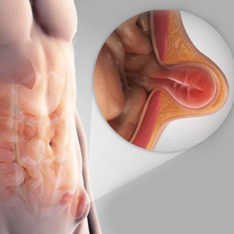 Βουβωνοκήλη