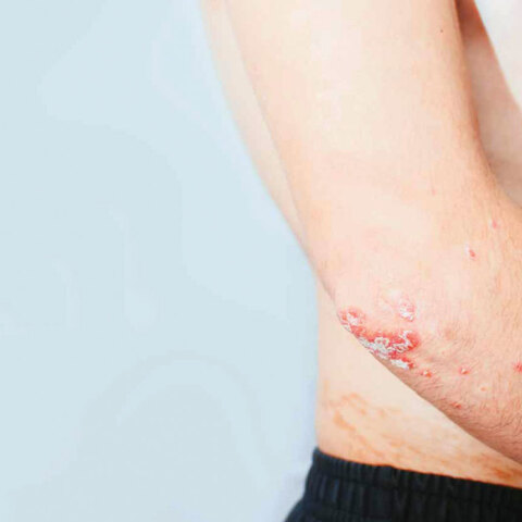 psoriasis3.jpg