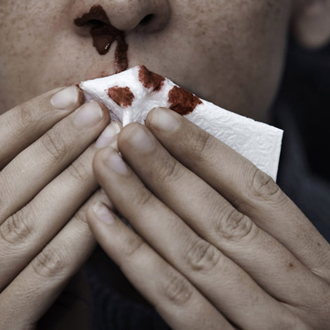 wbz-how-can-i-stop-a-nosebleed.jpg