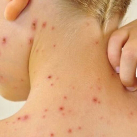 Κρούσματα ιλαράς 