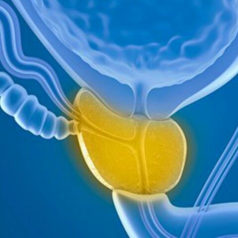 netaprostate-bph-s1.jpg