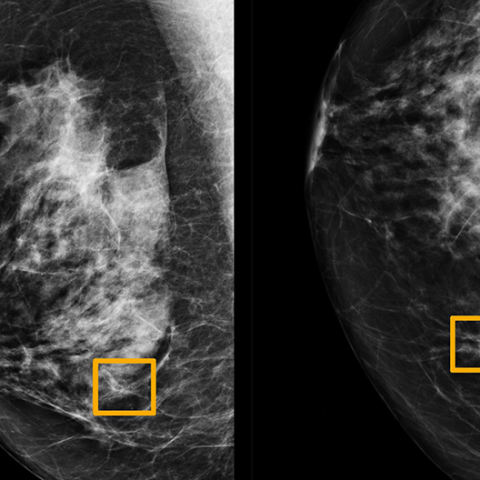Μαστογραφία και τεχνητή νοημοσύνη