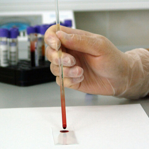 Αυξάνονται τα κρούσματα κορωνοϊού στην Κύπρο