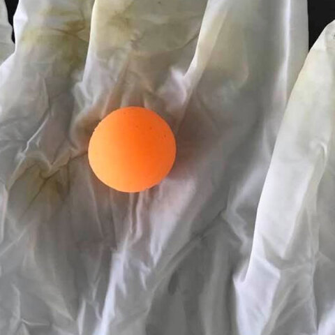 Παιδάκι κατάπιε μπαλάκι στη Χίο - Η ανάρτηση του γιατρού