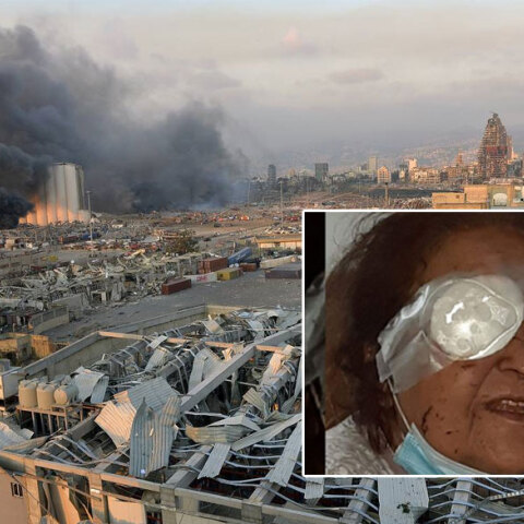 Έκρηξη στη Βηρυτό: Η Άννα Αρμάου, η Ελληνίδα που ζει μόνιμα στον Λίβανο και έχασε το μάτι της