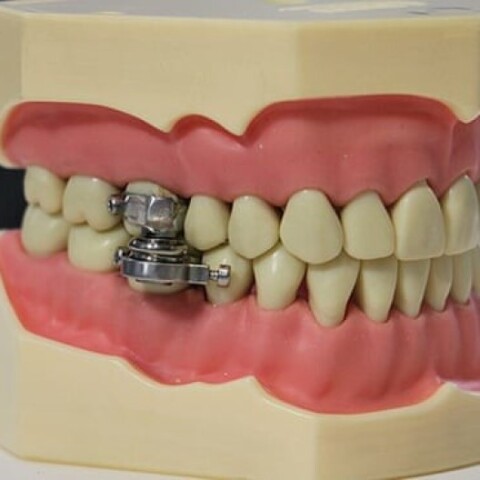 Η νέα συσκευή απώλειας βάρους © University of Otago