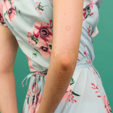 Ψωρίαση: Ποιες τροφές πρέπει να αποφεύγετε