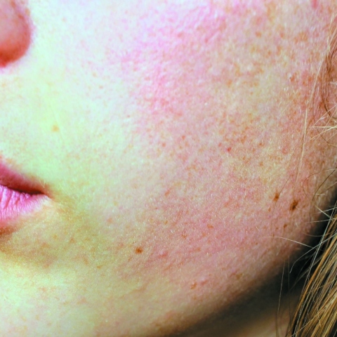 Πρόσωπο με σημάδια από ακμή