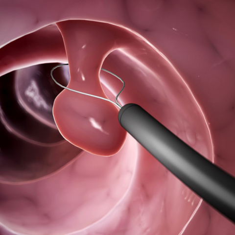 Καρκίνος παχέος εντέρου: Αποτελεσματική πρόληψη με κολονοσκόπηση