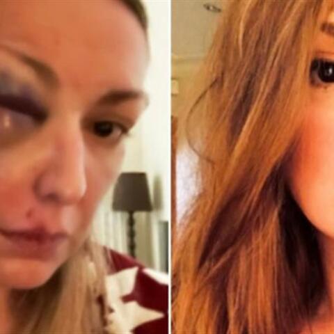 Μυστήριο με την Food Blogger που κατήγγειλε ότι έπεσε θύμα ξυλοδαρμού 