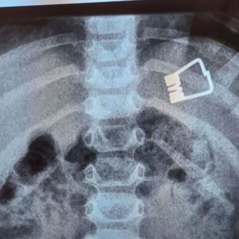 Ακτινογραφία με το μανταλάκι που κατάπιε το παιδάκι στη Λήμνο