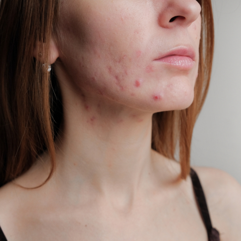 Ποιες οι επιπτώσεις της ακμής ενηλίκων στις γυναίκες;