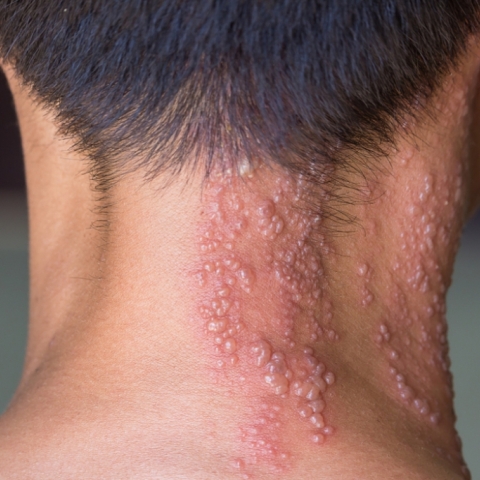 Στρες και έρπητας ζωστήρας: Υπάρχει σύνδεση; 