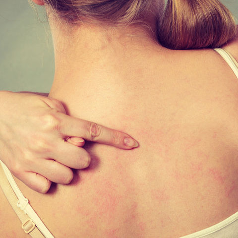 Δερματικό εξάνθημα