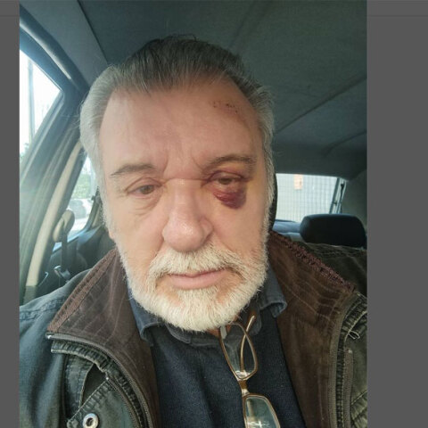 Ο Τάσος Χαλκιάς με μελανιασμένο μάτι μετά το ατύχημα