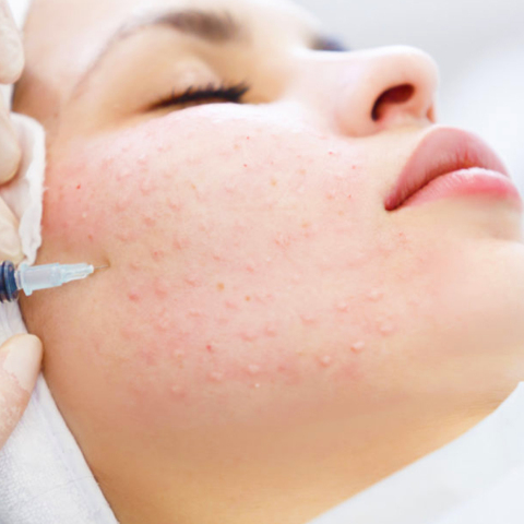 Προσφέρει όσα υπόσχεται η μεσοθεραπεία;