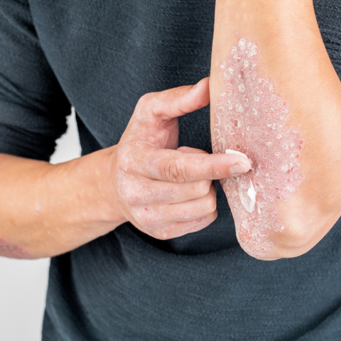 Πού οφείλεται η έξαρση των συμπτωμάτων της ψωρίασης τον χειμώνα;