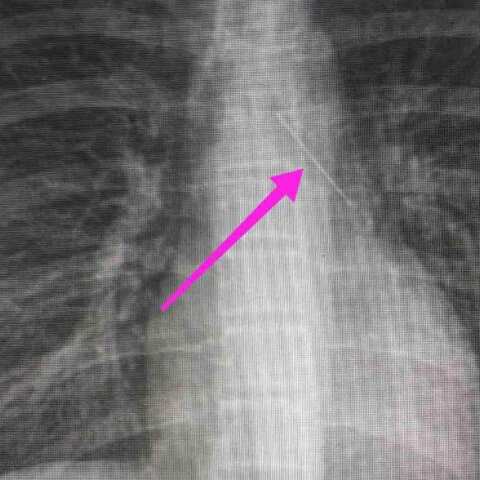 Θεσσαλονίκη: Ανήλικη κατάπιε καρφίτσα – Σωτήρια η επέμβαση των γιατρών στο Ιπποκράτειο Νοσοκομείο