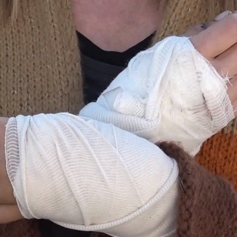 Γλυκά Νερά: Γυναίκα δέχθηκε άγρια επίθεση από πίτμπουλ στη μέση του δρόμου