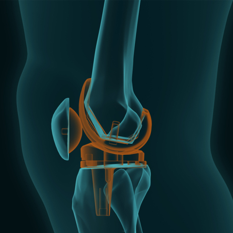 Aρθροπλαστική γόνατος και ισχίου: Τι ισχύει;