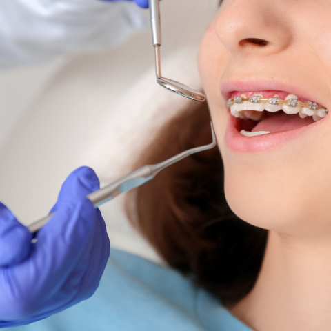 Kακή σύγκλειση των δοντιών: Πώς επηρεάζει τη στοματική υγεία