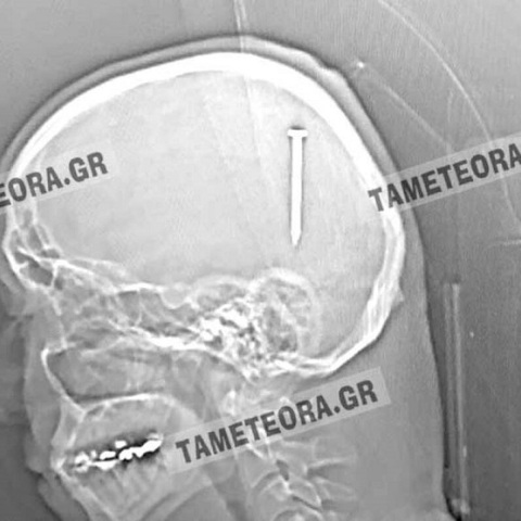 Καλαμπάκα: Καρφί 5 εκατοστών σφηνώθηκε στο κεφάλι άνδρα