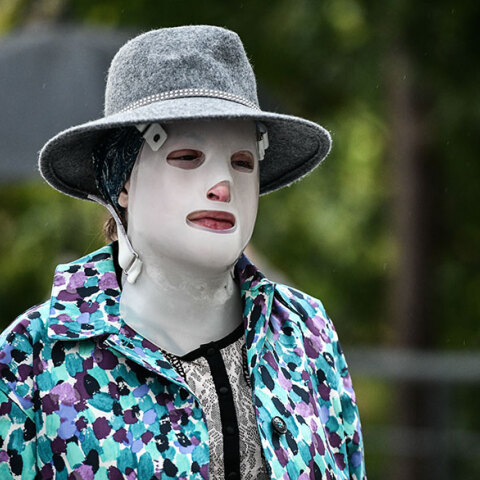 Η Ιωάννα Παλιοσπύρου με τη μάσκα στο πρόσωπο μετά την επίθεση με βιτριόλι