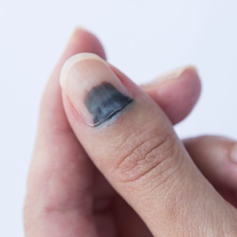 Μελανιά στο νύχι: Γιατί χρειάζεται άμεση ιατρική φροντίδα 