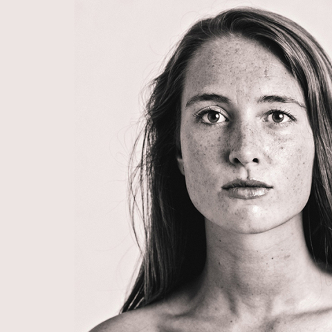 ασθενης με Νόσο του Χασιμότο