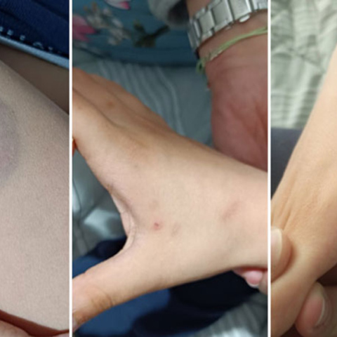 Άρτα: Διευθύντρια σχολείου δάγκωσε παιδί με αυτισμό