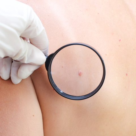 Μελάνωμα: Νεότερα δεδομένα δείχνουν αύξηση στους νέους 