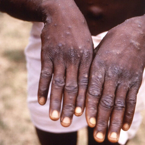 Ευλογιά των πιθήκων: Πολλές δεκάδες ύποπτα και επιβεβαιωμένα κρούσματα της ασθένειας έχουν εντοπιστεί στην Ευρώπη και τη Βόρεια Αμερική	