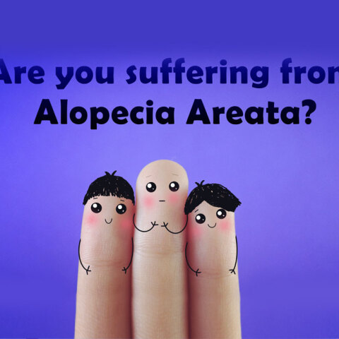 Αίτια, συμπτώματα και αντιμετώπιση της γυροειδούς αλωπεκίας 