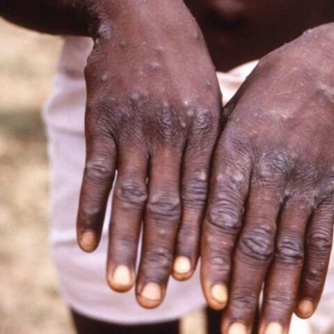 Ευλογιά των πιθήκων: Χέρια με τα σημάδια της νόσου