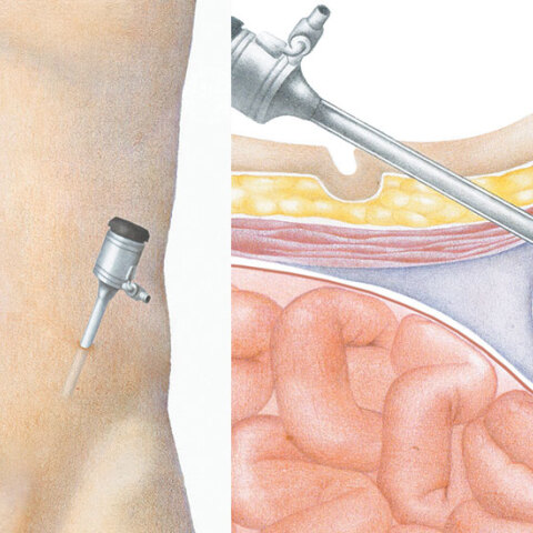 Εικονογράφηση λαπαροσκοπικής αντιμετώπισης της κήλης