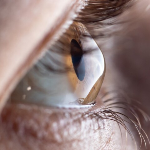 Από ποια οφθαλμοπάθεια πάσχει ένας στους δέκα Έλληνες; 