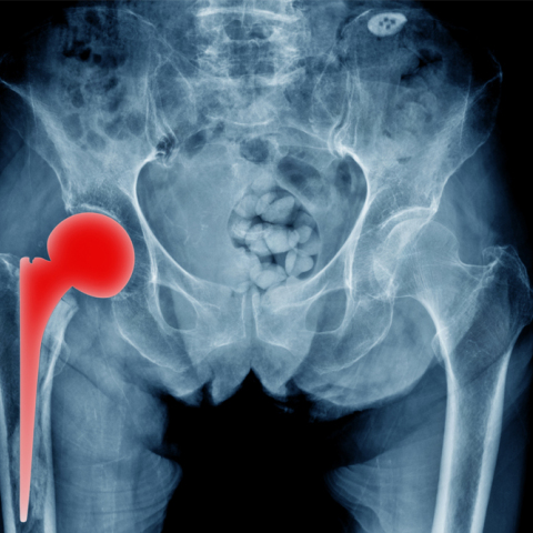 Oλική αρθροπλαστική ισχίου: Η τεχνική Super PATH