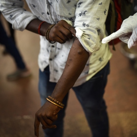 Ευλογιά των πιθήκων - Γυναίκα που ελέγχεται για συμπτώματα στο κορμί της