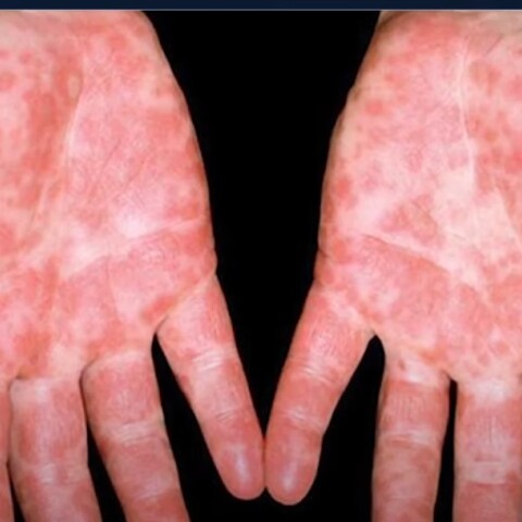 Η γρίπη της ντομάτας - Εξανθήματα στα χέρια