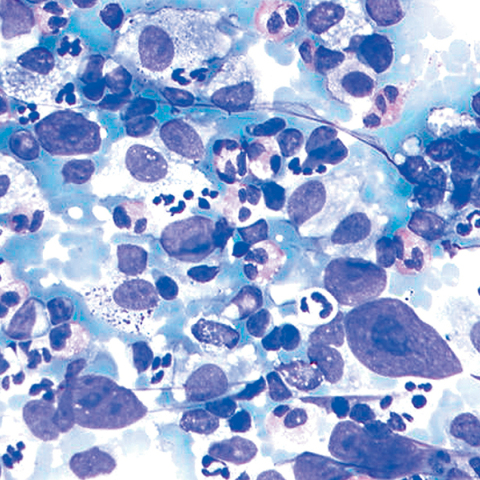 μη-Hodgkin λέμφωμα (ΜΗΛ)