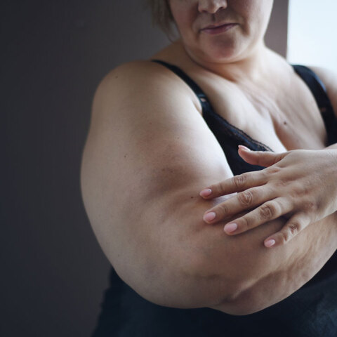 Παχύσαρκη γυναίκα