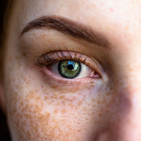 Οφείλονται στον ήλιο οι άσπρες κηλίδες στο δέρμα;