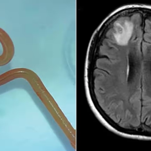 Αυστραλία: Βρέθηκε ζωντανό παρασιτικό σκουλήκι μήκους οκτώ εκατοστών στον εγκέφαλο ασθενούς - Τι σημαίνει το εύρημα για τις αναδυόμενες λοιμώξεις παγκοσμίως.