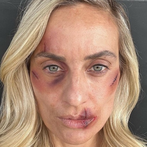 Η Ελεονώρα με μώλωπες στο πρόσωπό της ως θύμα κακοποίησης